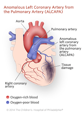 Anomalous Left Coronary Artery From the Pulmonary Artery Illustration