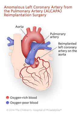 Anomalous Left Coronary Artery From the Pulmonary Artery Reimplantation Surgery Illustration