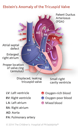Ebstein’s Anomaly of the Tricuspid Valve Illustration