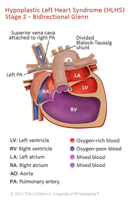Hypoplastic Left Heart Syndrome Stage 2 Repair Illustration