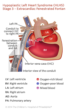 Hypoplastic Left Heart Syndrome Stage 3 Repair Illustration
