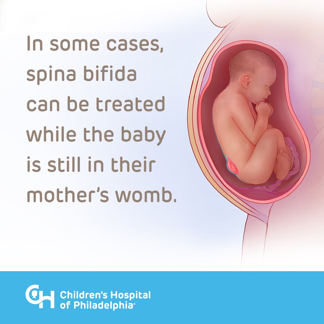 In some cases, spina bifida can be treated while the baby is still in their mother's womb.