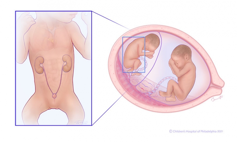 Twin-to-twin transfusion syndrome (TTTS) stage 2 illustration