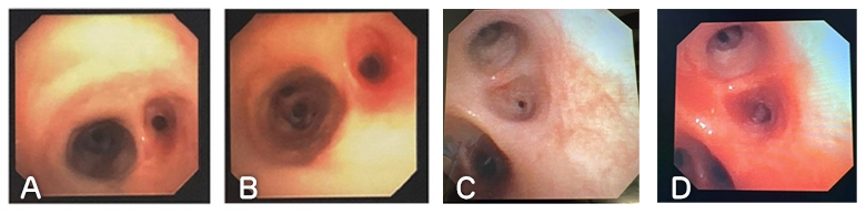 Bronchus images before and after balloon dilation, side by side