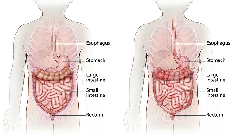 GI tract normal vs. Crohn's Disease cropped illustration