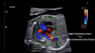 connection between right pulmonary artery (blue vessel) and right pulmonary vein (red vessel).