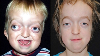 Craniosynostosis Syndromic Crouzon Patient Before and After