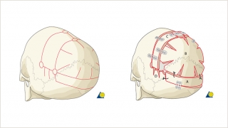 Demonstration of the bony cuts of a posterior vault remodeling