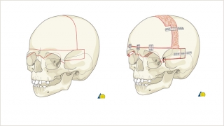 Demonstration of the bony cuts of a bilateral frontal orbital advancement