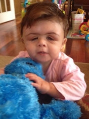 Saethre-Chotzen Syndrome and Encephalocele: Elana’s Story - Baby
