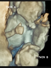 Twin-to-twin transfusion syndrome (TTTS) shown on 3D fetal ultrasound