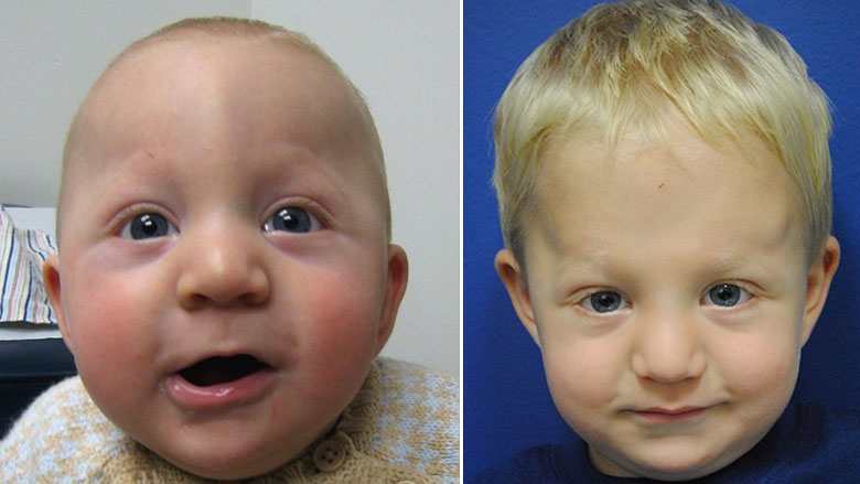 Side by side images of before and after surgical correction of metopic synostosis
