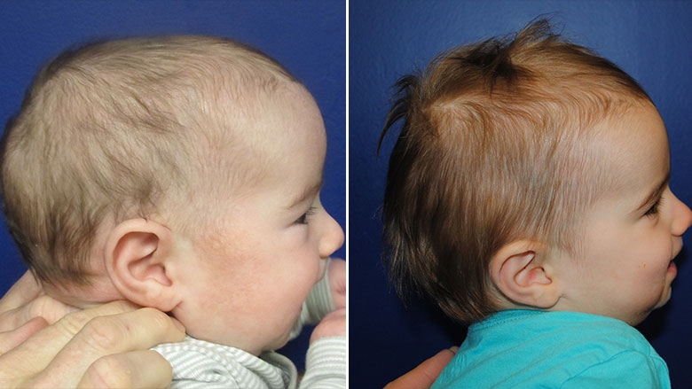 Pre-operative and post-operative comparison of sagittal synostosis corrected in infancy with cranial spring placement.