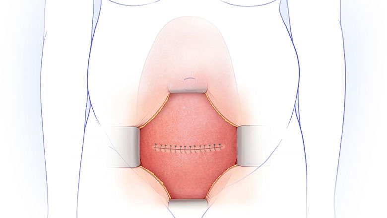 Illustration of uterus closure in MMC fetal surgery