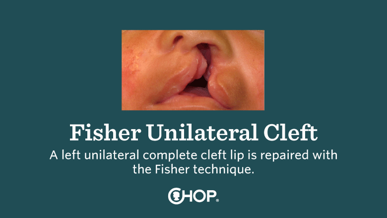 Fisher Cleft Lip Slide 1