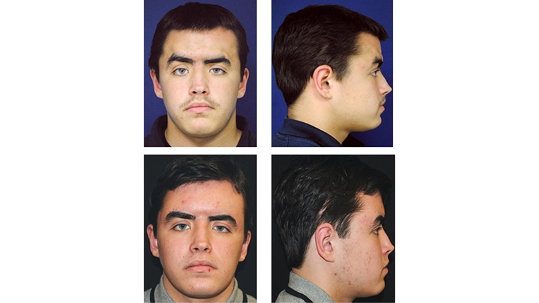Patient pre- and post- final facial contouring