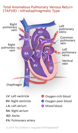 Total Anomalous Pulmonary Venous Return Infradiaphragmatic Type Illustration