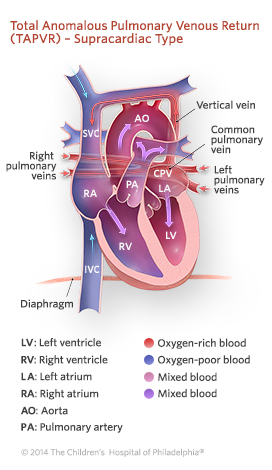 Total Anomalous Pulmonary Venous Return Supracardiac Type Illustration