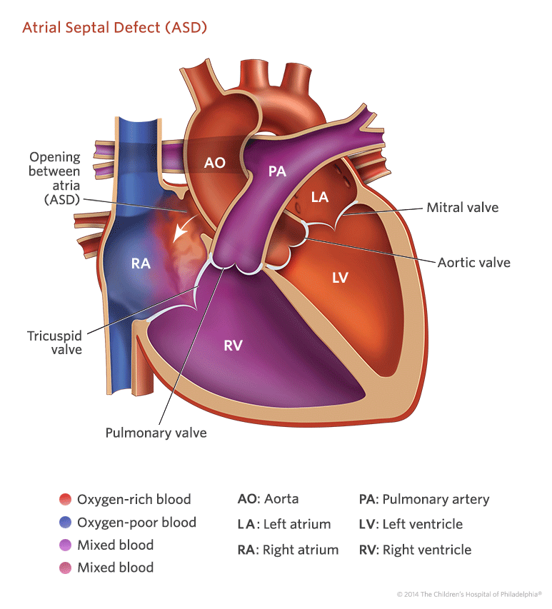 Дефект межпредсердной перегородки. Atrial Septal defect (ASD). Дефект межпредсердной перегородки окклюдером. Дефект межпредсердной перегородки у новорожденного ASD.