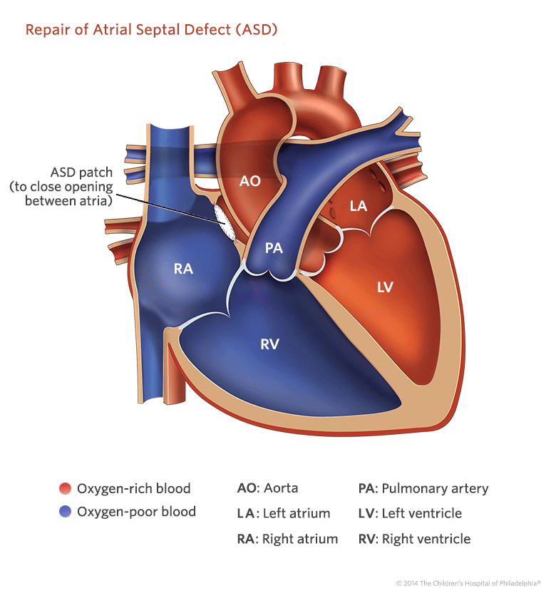 Atrial Septal Defect Repair