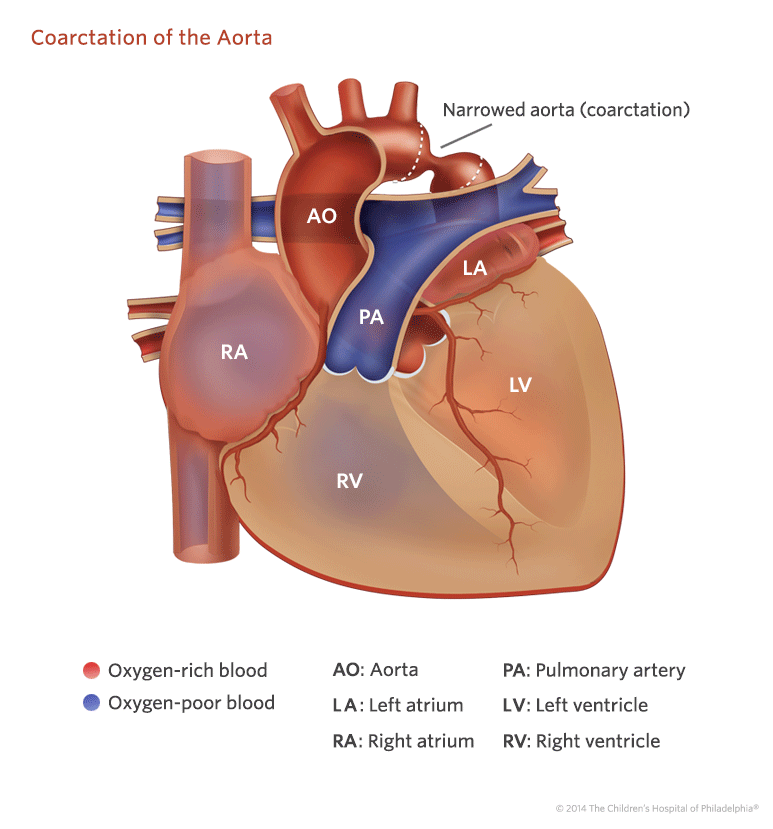 Coarctation Of The Aorta Childrens Hospital Of Philadelphia