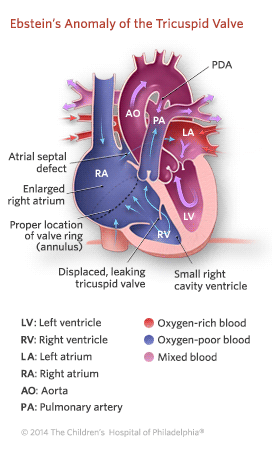 About Ebstein’s Anomaly of the Tricuspid Valve | The Children's ...