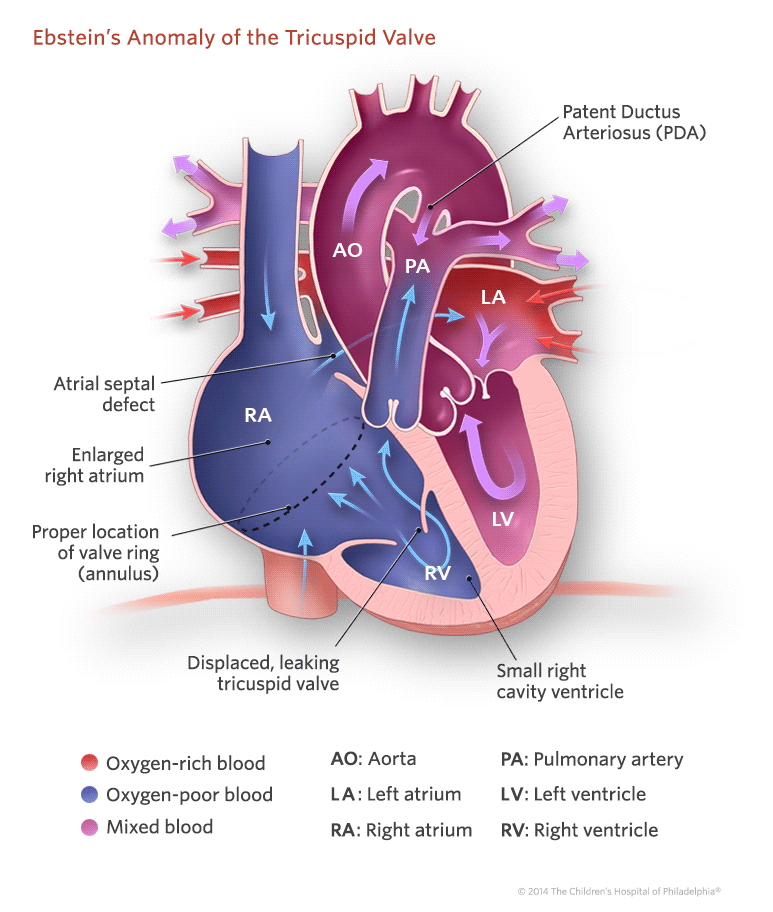 aortic-regurgitation-what-is-it-causes-osmosis