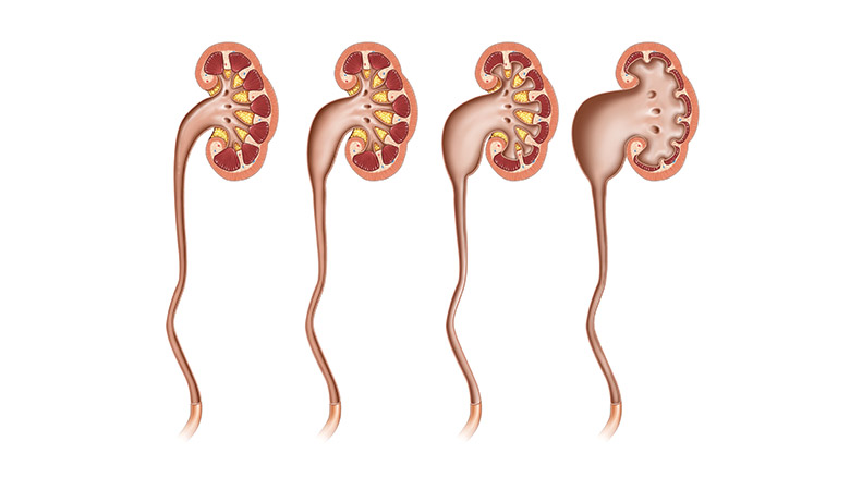 Hydronephrosis in Children  Symptoms, Causes, Treatment and other