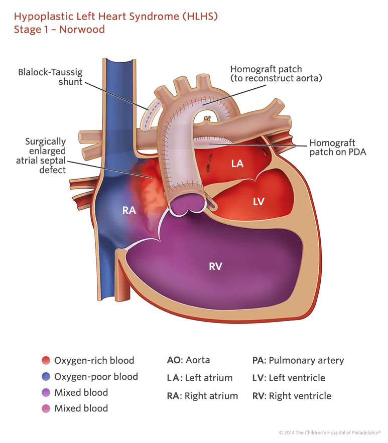 Staged Reconstruction Heart Surgery | Children's Hospital of Philadelphia