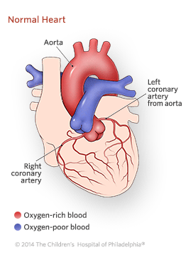 Anomalous Left Coronary Artery From The Pulmonary Artery Children S Hospital Of Philadelphia