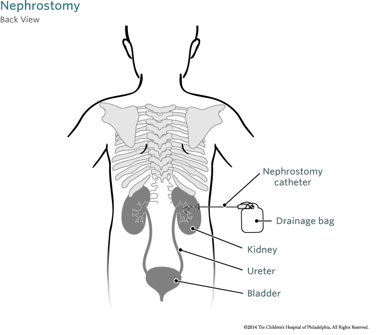 nephrostomy-tube-children-s-hospital-of-philadelphia