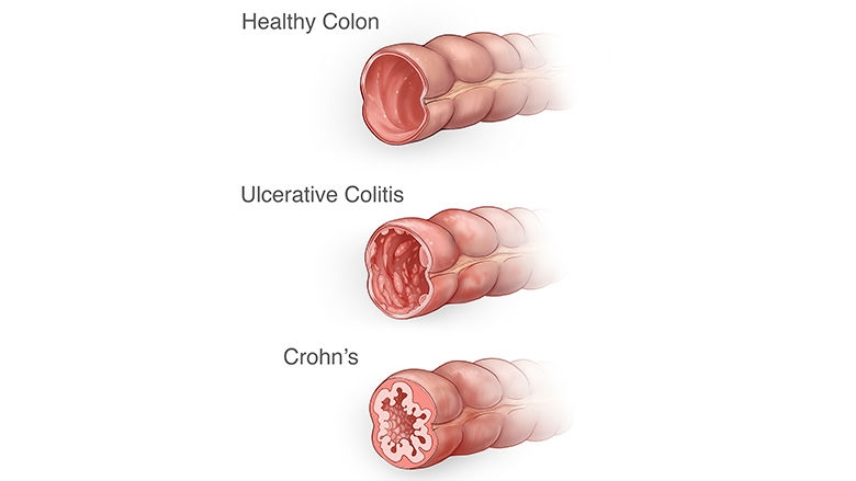 Ulcerative Colitis Diagnosis and Testing: How It Works