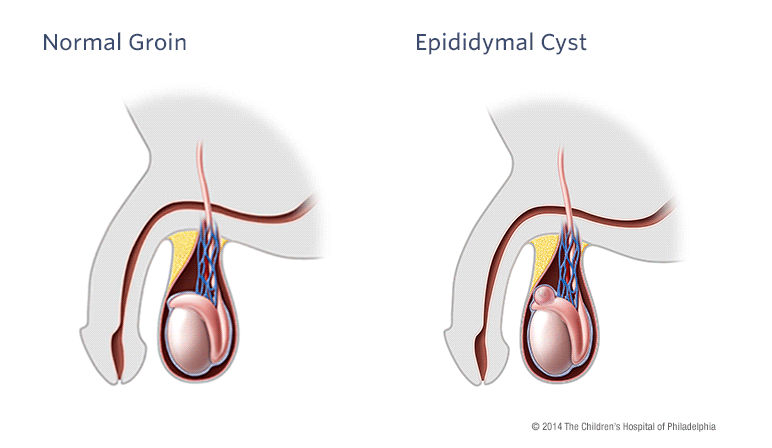 Epididymal Cyst and Spermatocele  Children's Hospital of Philadelphia