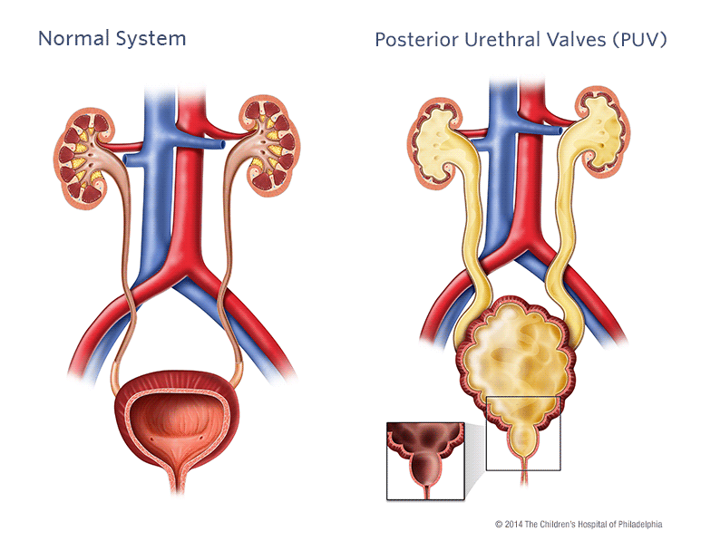 Posterior Urethral Valves Puv Children S Hospital Of Philadelphia
