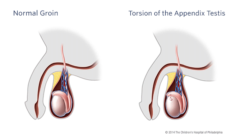Torsion of the Appendix Illustration