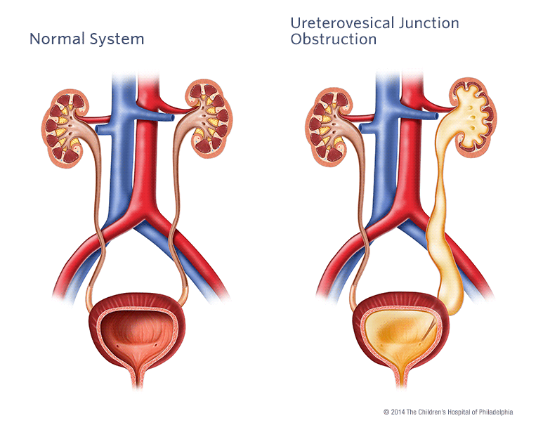 Ureterovesical Junction (UVJ) Obstruction