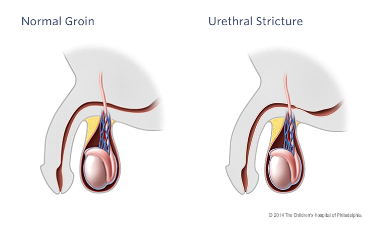 Urethral Stricture: Symptoms, Causes, Treatment & Prevention