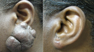 Earlobe Repair, Keloids on Ears