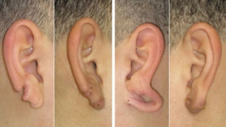 How to Treat a Torn Earlobe at Home and at the Clinic