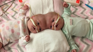 Formerly Conjoined Twins Erin And Abby Delaney Thriving Months After Separation Surgery Children S Hospital Of Philadelphia