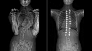 Choosing the Right Scoliosis Brace for Effective Treatment