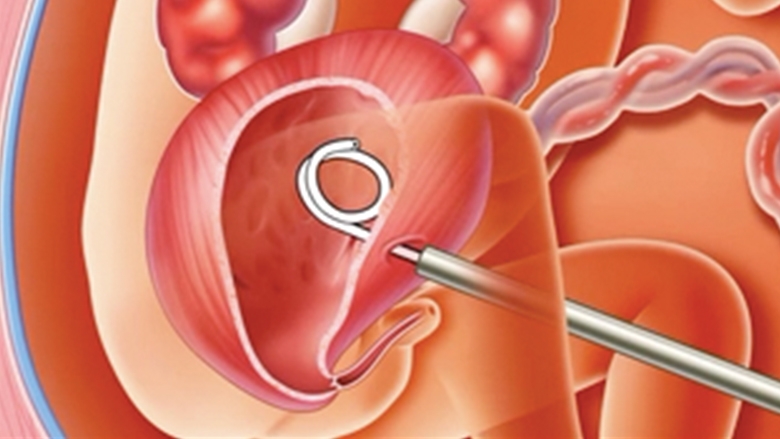 Lower Urinary Tract Obstruction - Fetal Health Foundation