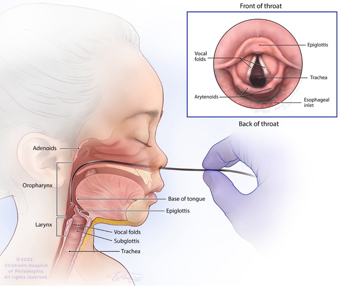 Flexible Laryngoscopy Treatment