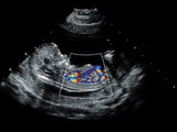 fetal echocardiogram