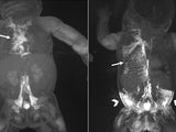 MRIs showing dynamic contrast MR lymphangiography (DCMRL) in neonatal chylothorax and CLFD