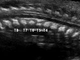 Fetal CT showing sagittal view of single anomalous vertebrae