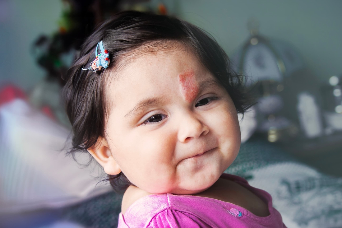 Young girl with a vascular anomaly smiling