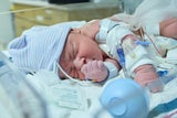 Newborn baby hooked up to IV