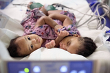 Conjoined newborn twins laying in a hospital bed, one looking at the camera