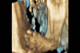 3-D ultrasounds of clubfoot